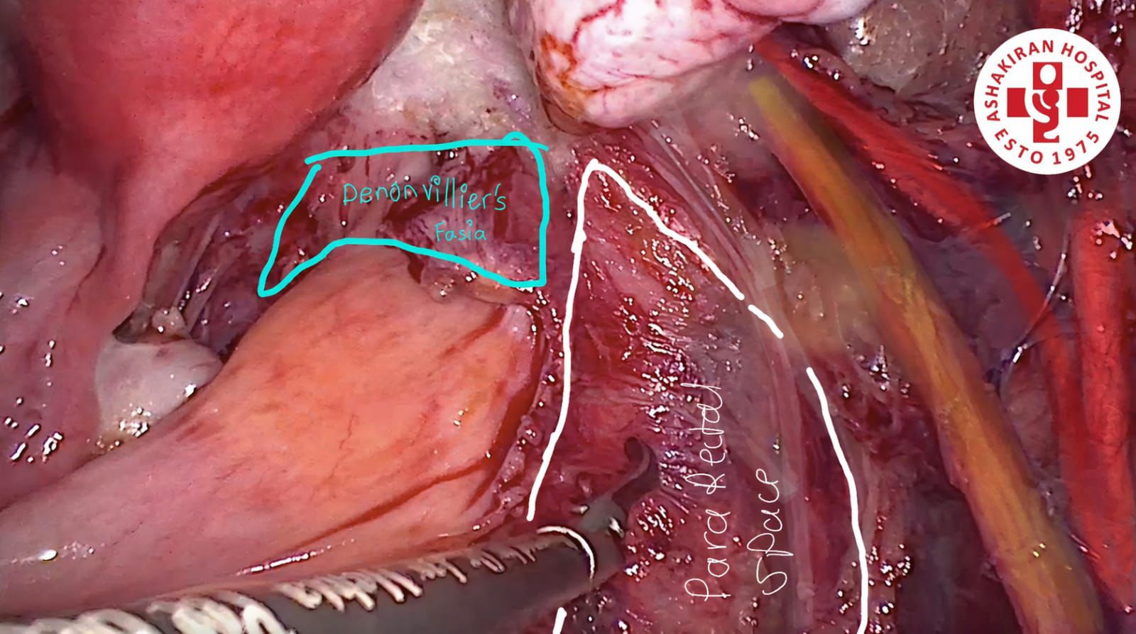 The Pelvic Compass: Learn, Visualize, Operate | Pelvic Anatomy Guide